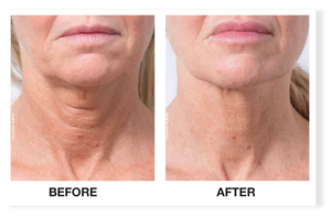 RF (Radio Frequency) Microneedling