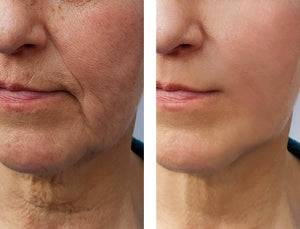 RF (Radio Frequency) Microneedling